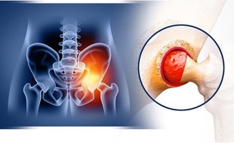 Managing Swelling 3 Months After Hip Replacement